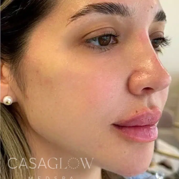 after-facial-balancing-treatment-at-casaglow-medspa
