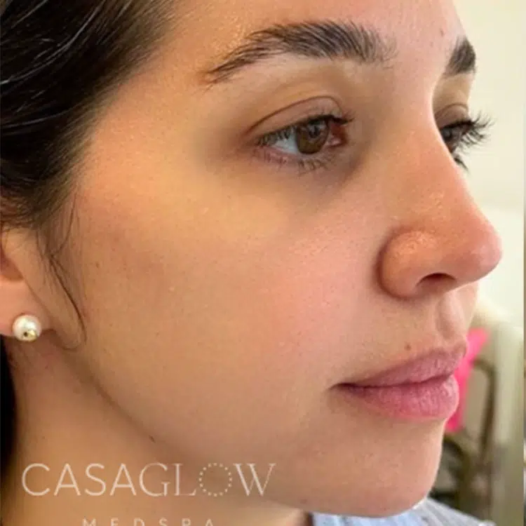 before-facial-balancing-treatment-at-casaglow-medspa