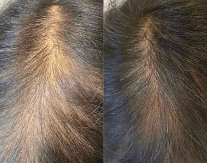 prp hair restoration before and after photo by casaglow medspa in new york ny