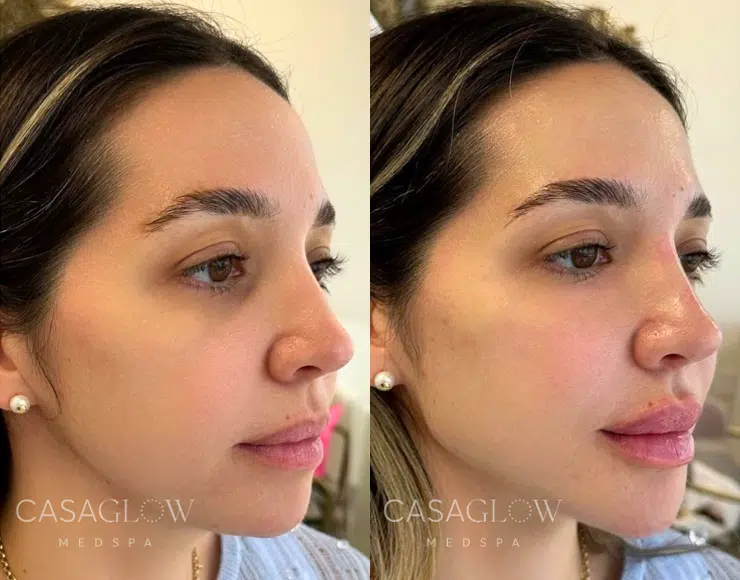 facial fillers before and after photo by casaglow medspa in new york ny