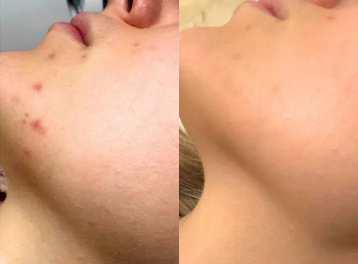 skin laser genesis before and after photo by casaglow medspa in new york ny