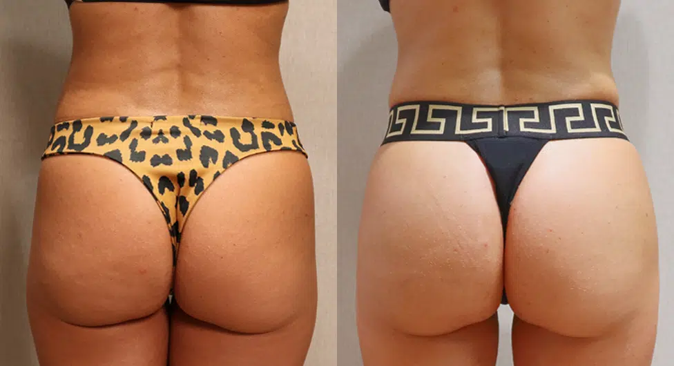 bbl before and after photo by casaglow medspa in new york ny