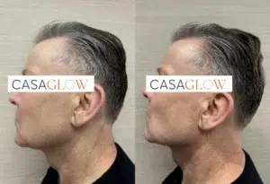 facial fillers before and after photo by casaglow medspa in new york ny