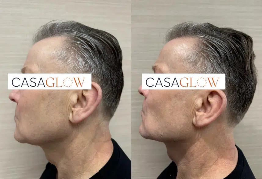 facial fillers before and after photo by casaglow medspa in new york ny