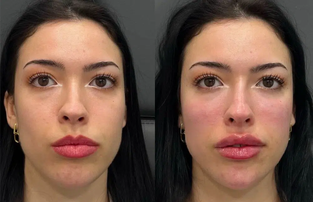 facial fillers before and after photo by casaglow medspa in new york ny