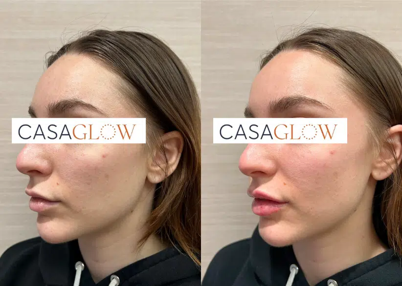 facial fillers before and after photo by casaglow medspa in new york ny