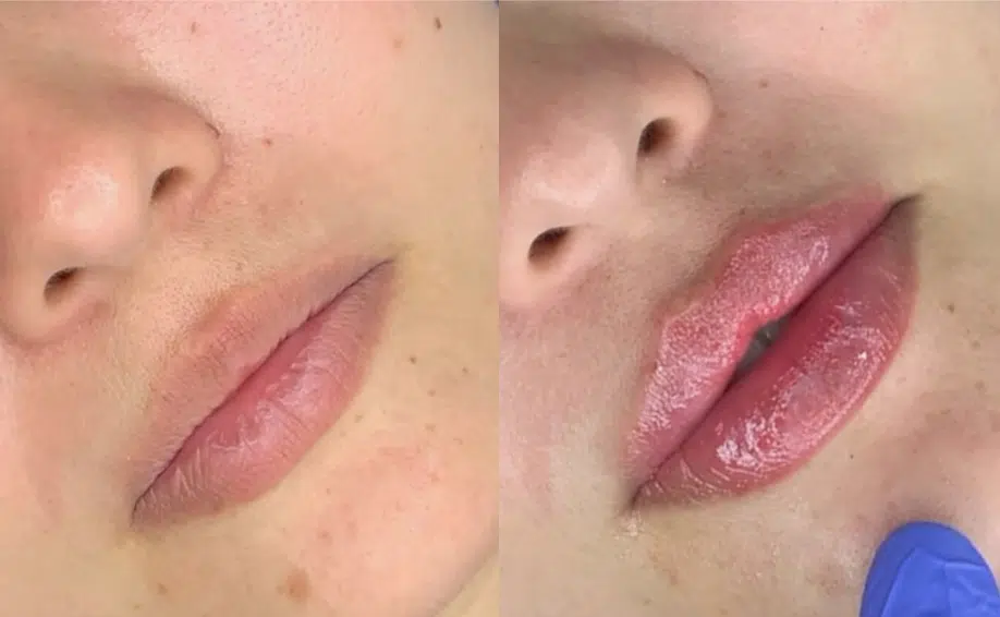 facial fillers before and after photo by casaglow medspa in new york ny