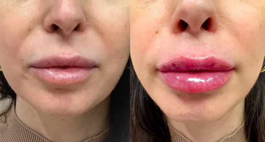 facial fillers before and after photo by casaglow medspa in new york ny