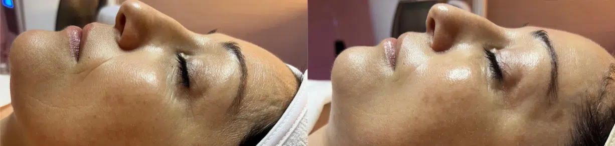 environ triawave before and after photo by casaglow medspa in new york ny