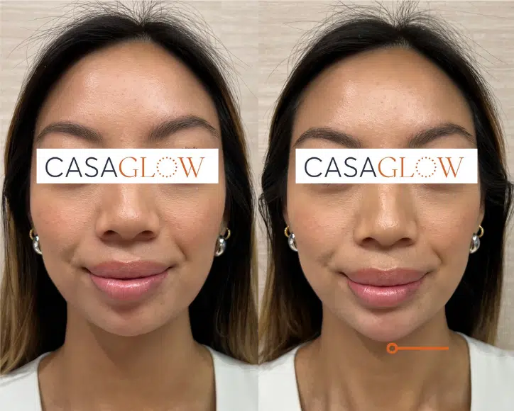 facial fillers before and after photo by casaglow medspa in new york ny