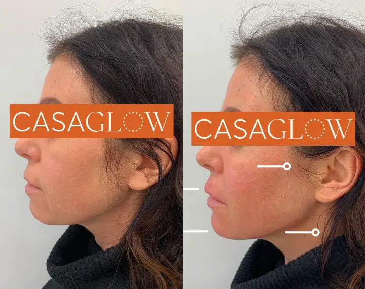 facial fillers before and after photo by casaglow medspa in new york ny