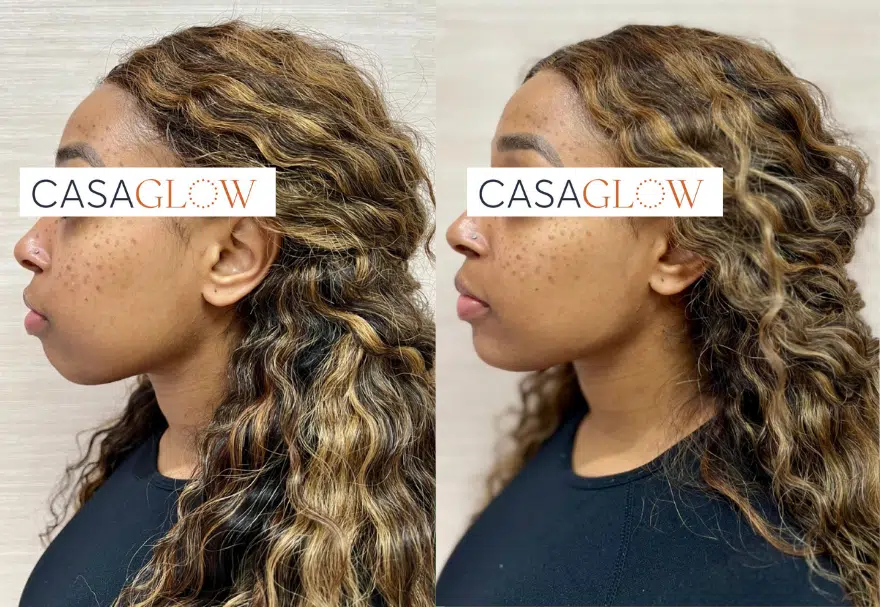 facial fillers before and after photo by casaglow medspa in new york ny