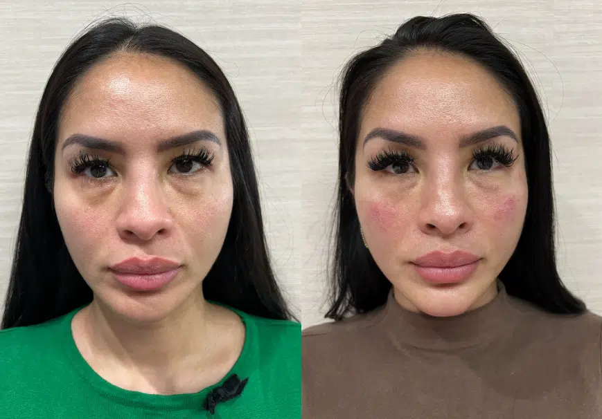 facial fillers before and after photo by casaglow medspa in new york ny