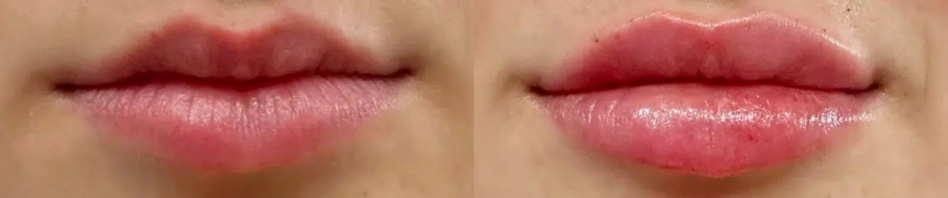 facial fillers before and after photo by casaglow medspa in new york ny