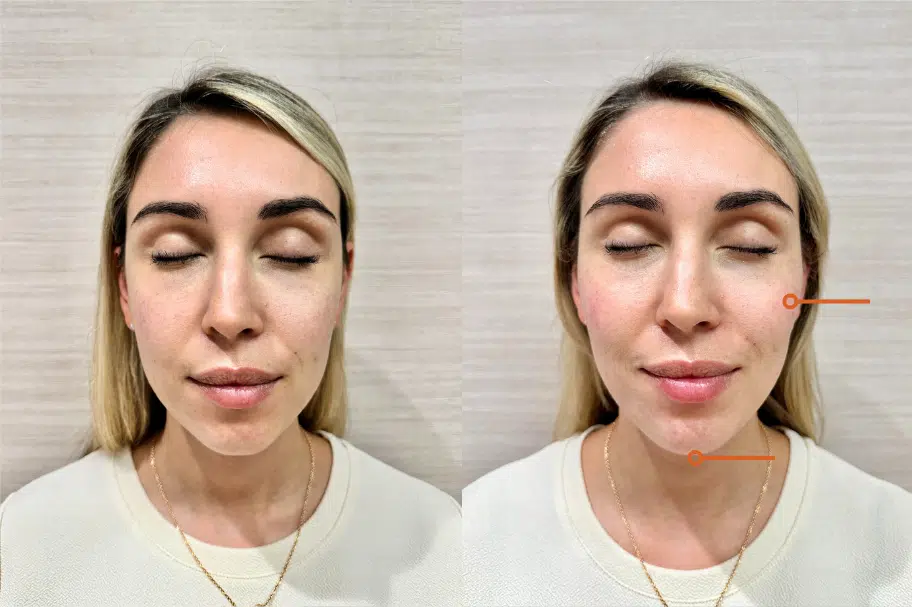 facial fillers before and after photo by casaglow medspa in new york ny
