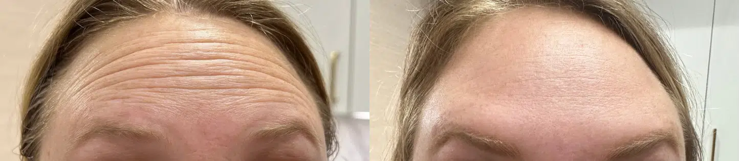 neurotoxins before and after photo by casaglow medspa in new york ny