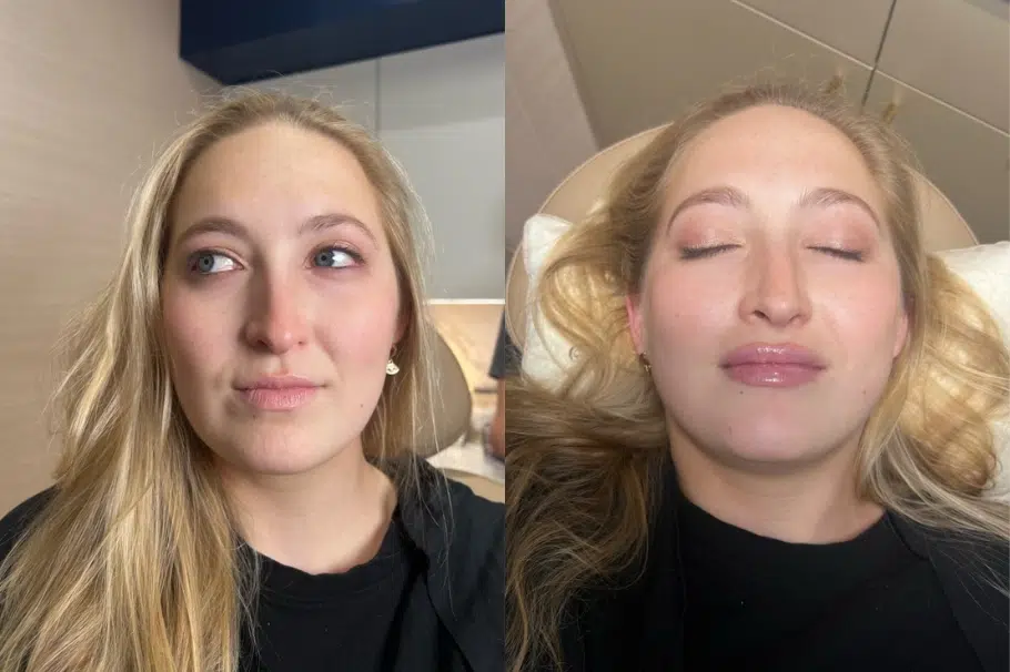 facial fillers before and after photo by casaglow medspa in new york ny