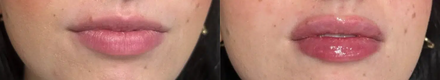 facial fillers before and after photo by casaglow medspa in new york ny