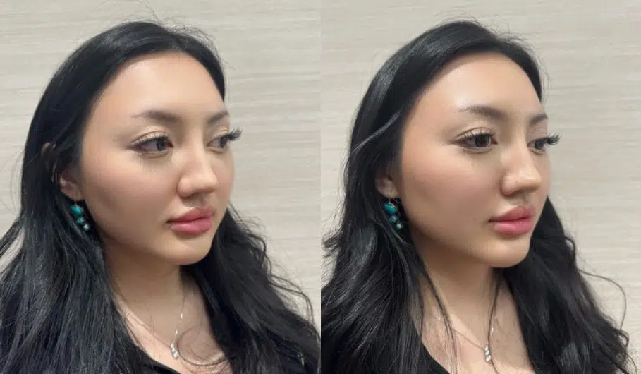facial fillers before and after photo by casaglow medspa in new york ny