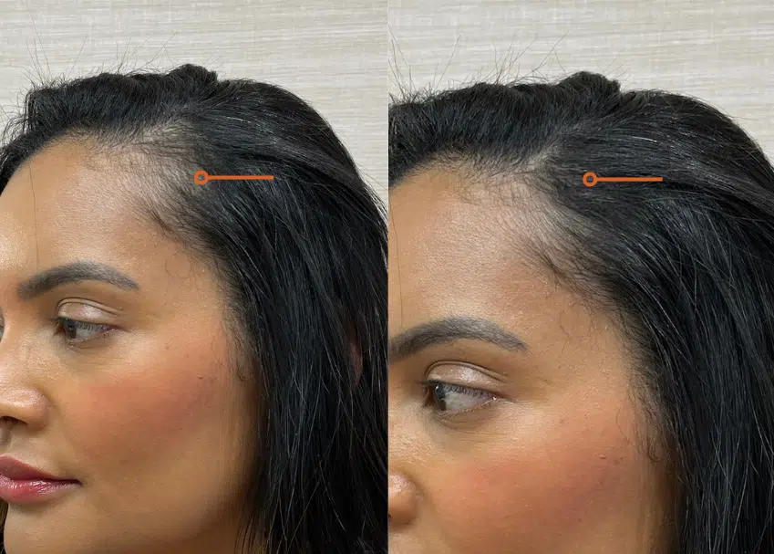 prp hair restoration before and after photo by casaglow medspa in new york ny