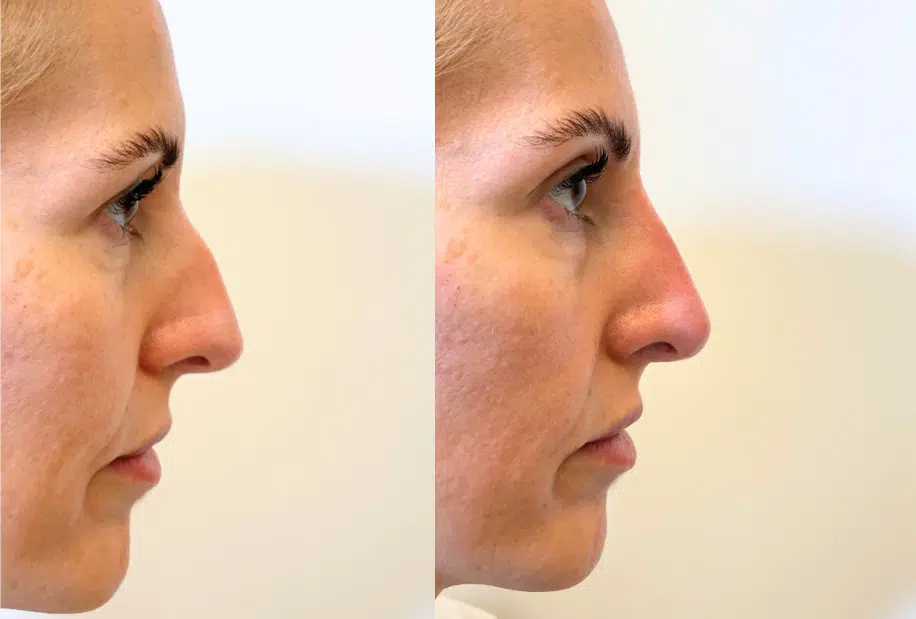 facial fillers before and after photo by casaglow medspa in new york ny