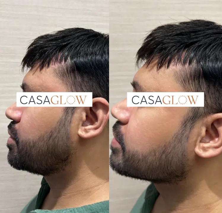 facial fillers before and after photo by casaglow medspa in new york ny