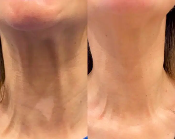 neurotoxins before and after photo by casaglow medspa in new york ny
