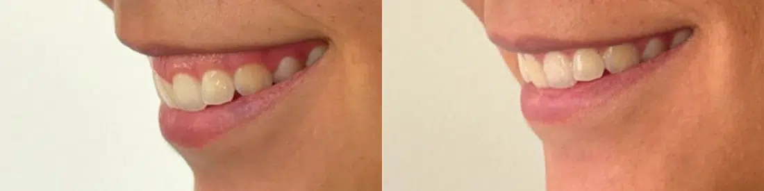 neurotoxins before and after photo by casaglow medspa in new york ny