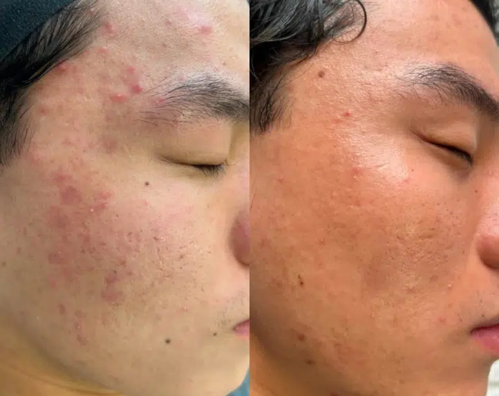 skin laser genesis before and after photo by casaglow medspa in new york ny