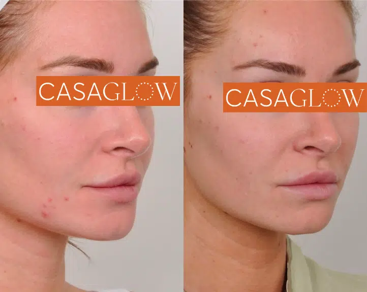 vi peels before and after photo by casaglow medspa in new york ny
