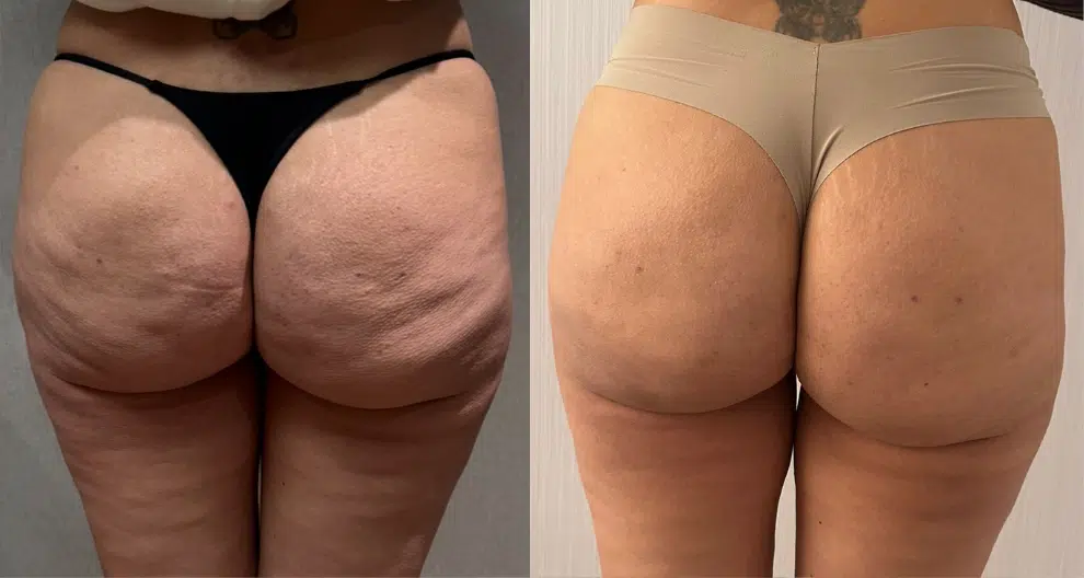 cellulite treatment before and after photo by casaglow medspa in new york ny