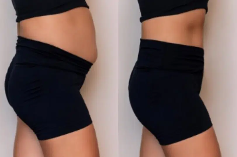 lymphatic drainage massage before and after photo by casaglow medspa in new york ny