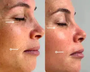 secret duo skin tightening before and after photo by casaglow medspa in new york ny
