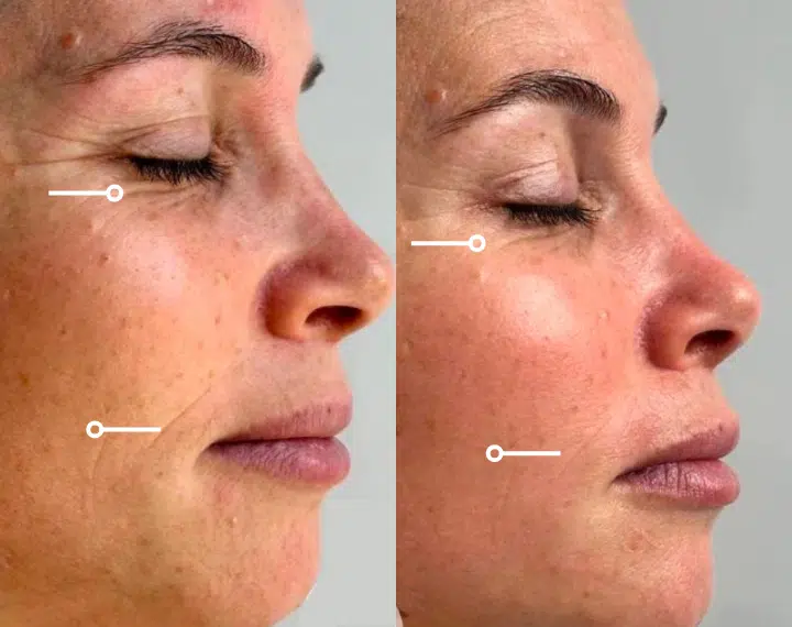 secret duo skin tightening before and after photo by casaglow medspa in new york ny