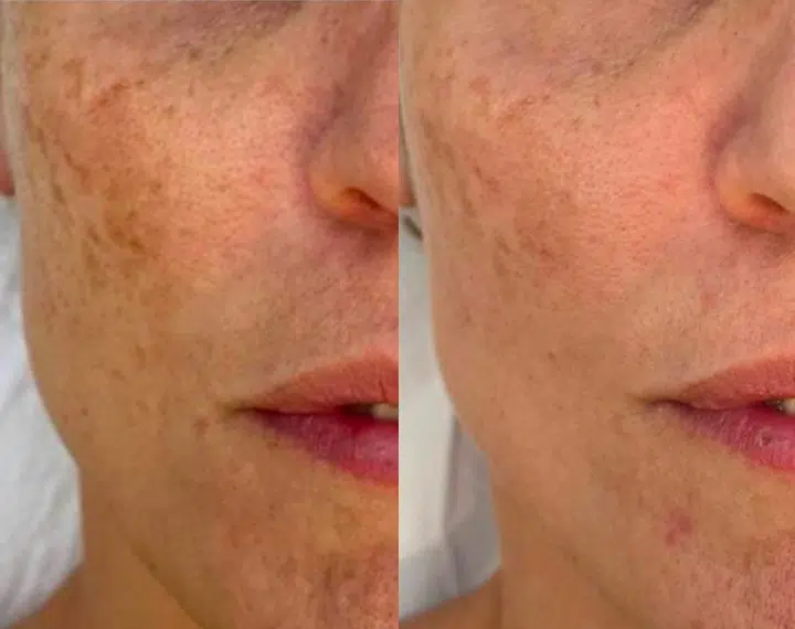 secret duo skin tightening before and after photo by casaglow medspa in new york ny