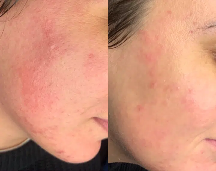 skin laser genesis before and after photo by casaglow medspa in new york ny