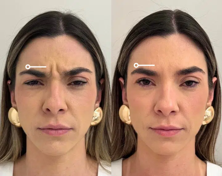neurotoxins before and after photo by casaglow medspa in new york ny