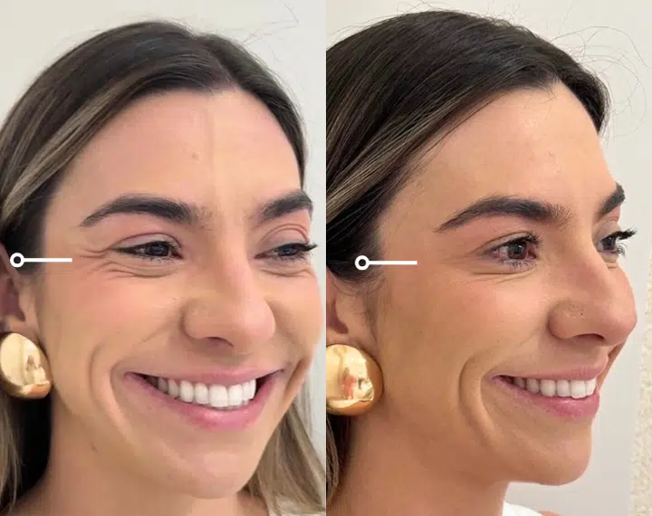 neurotoxins before and after photo by casaglow medspa in new york ny