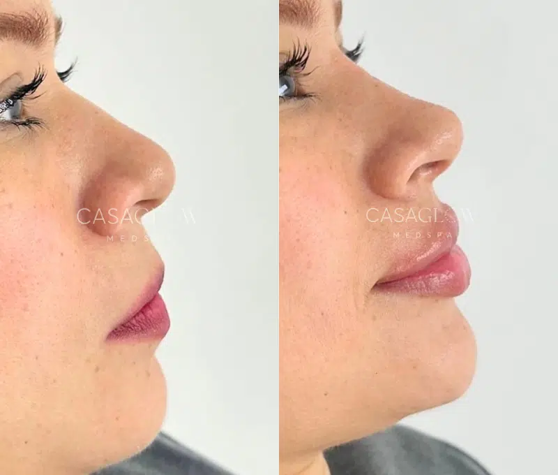 facial fillers before and after photo by casaglow medspa in new york ny
