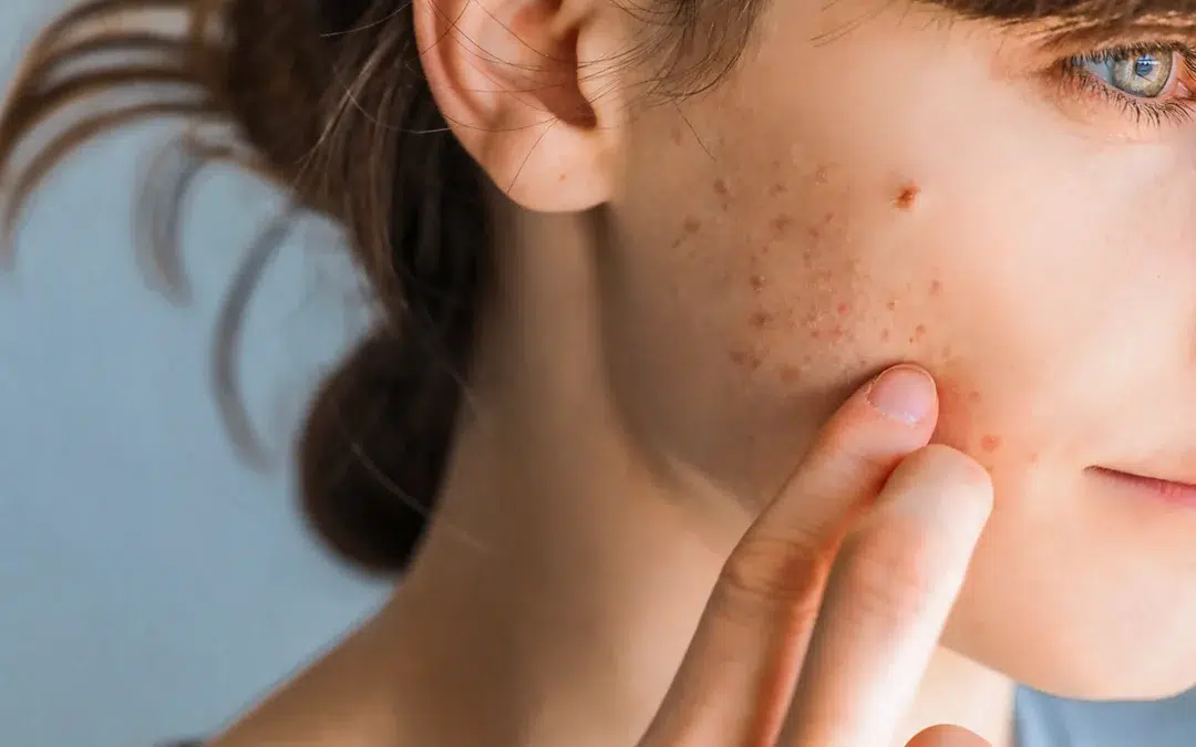 How Can You Achieve Clear Skin with Effective Acne Relief Strategies?