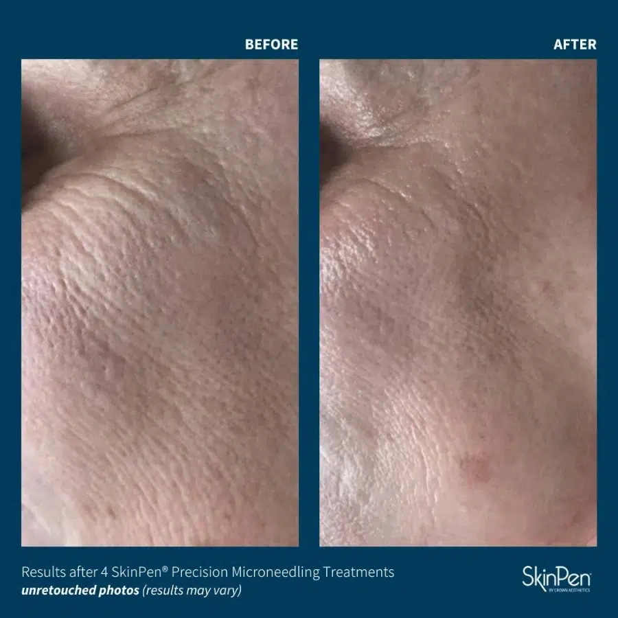 before and after microneedling at casaglow medspa before and after microneedling at casaglow medspa