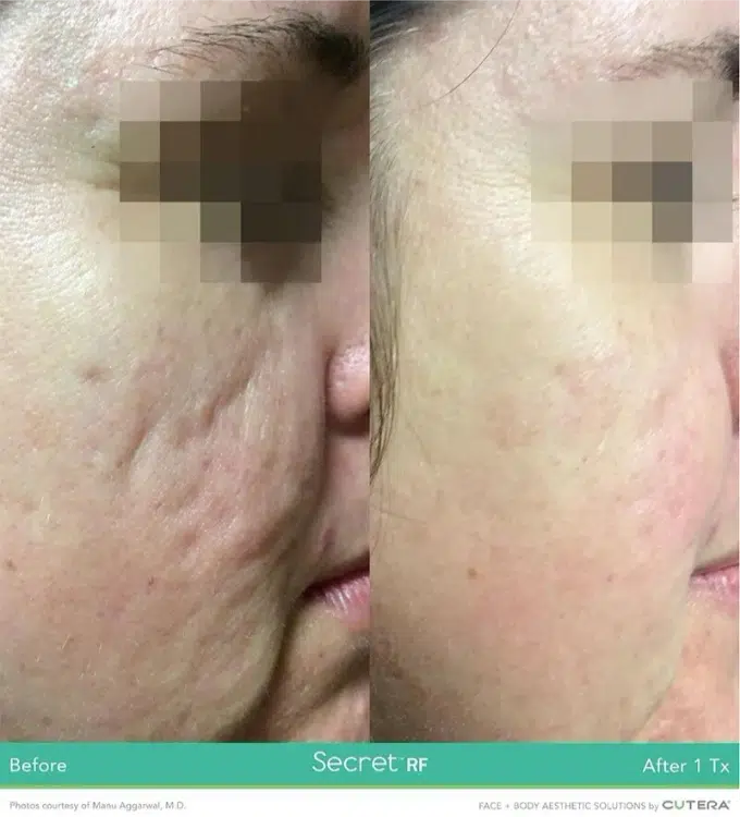 before and after rf microneedling at casaglow medspa