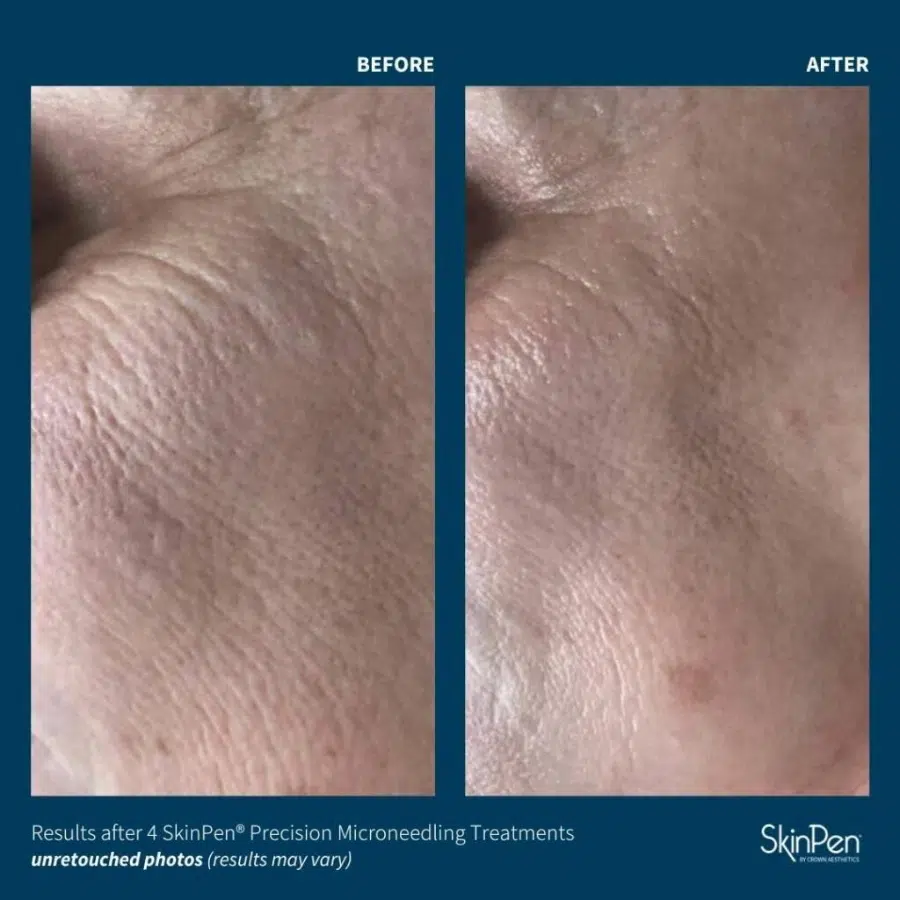before and after skinpen microneedling at casaglow before and after skinpen microneedling at casaglow