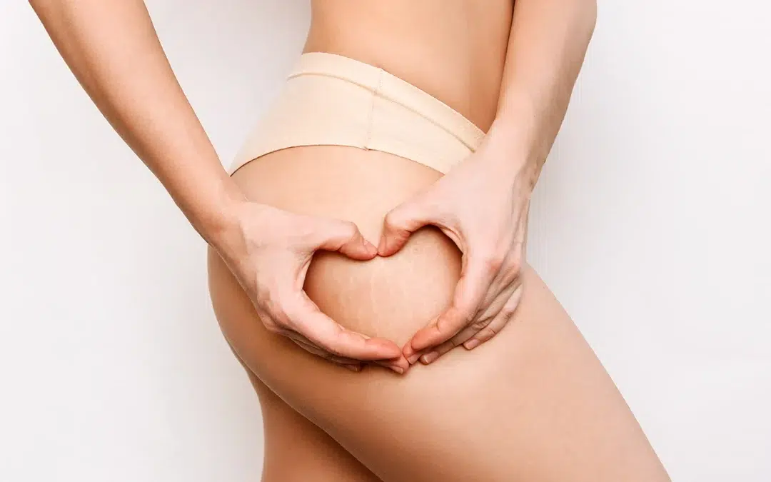 Carboxy Therapy: The Innovative Solution for Cellulite & Stretch Mark Reduction