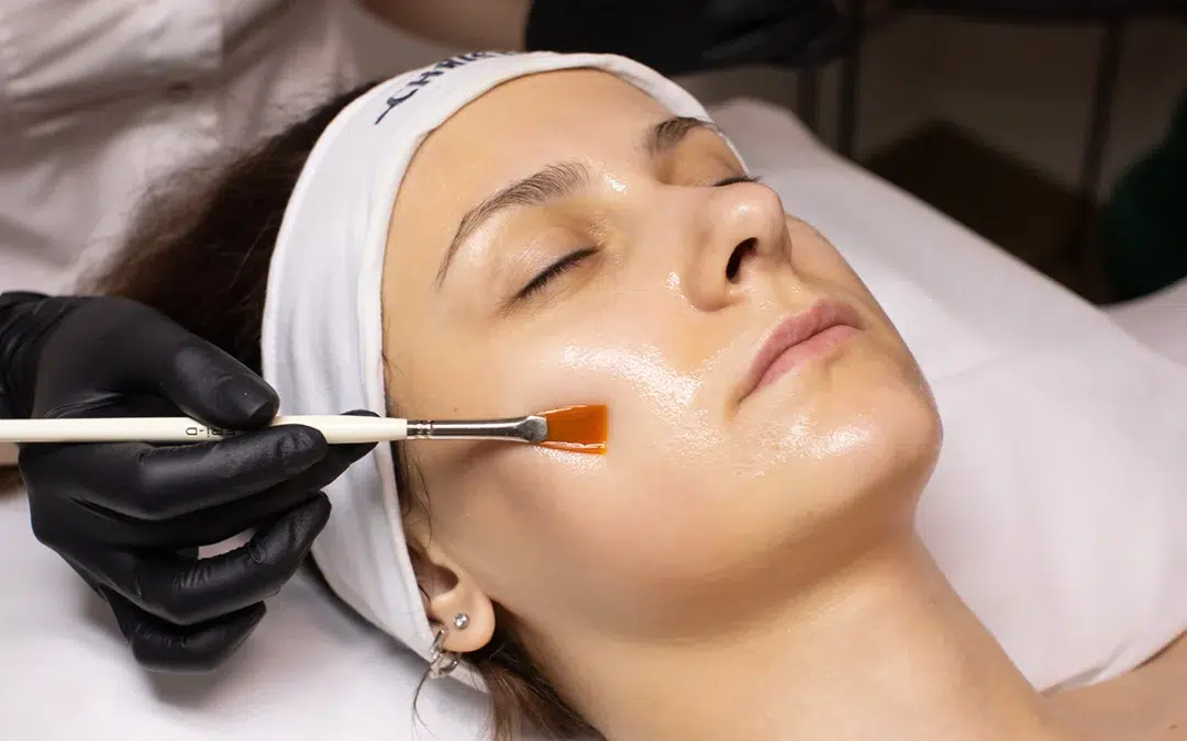 Glow Deeper: The Benefits of Chemical Peels and Why Your Skin Will Thank You